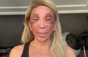 Maya Massafera choca ao aparecer com rosto ferido após peeling: "Não consigo rir"